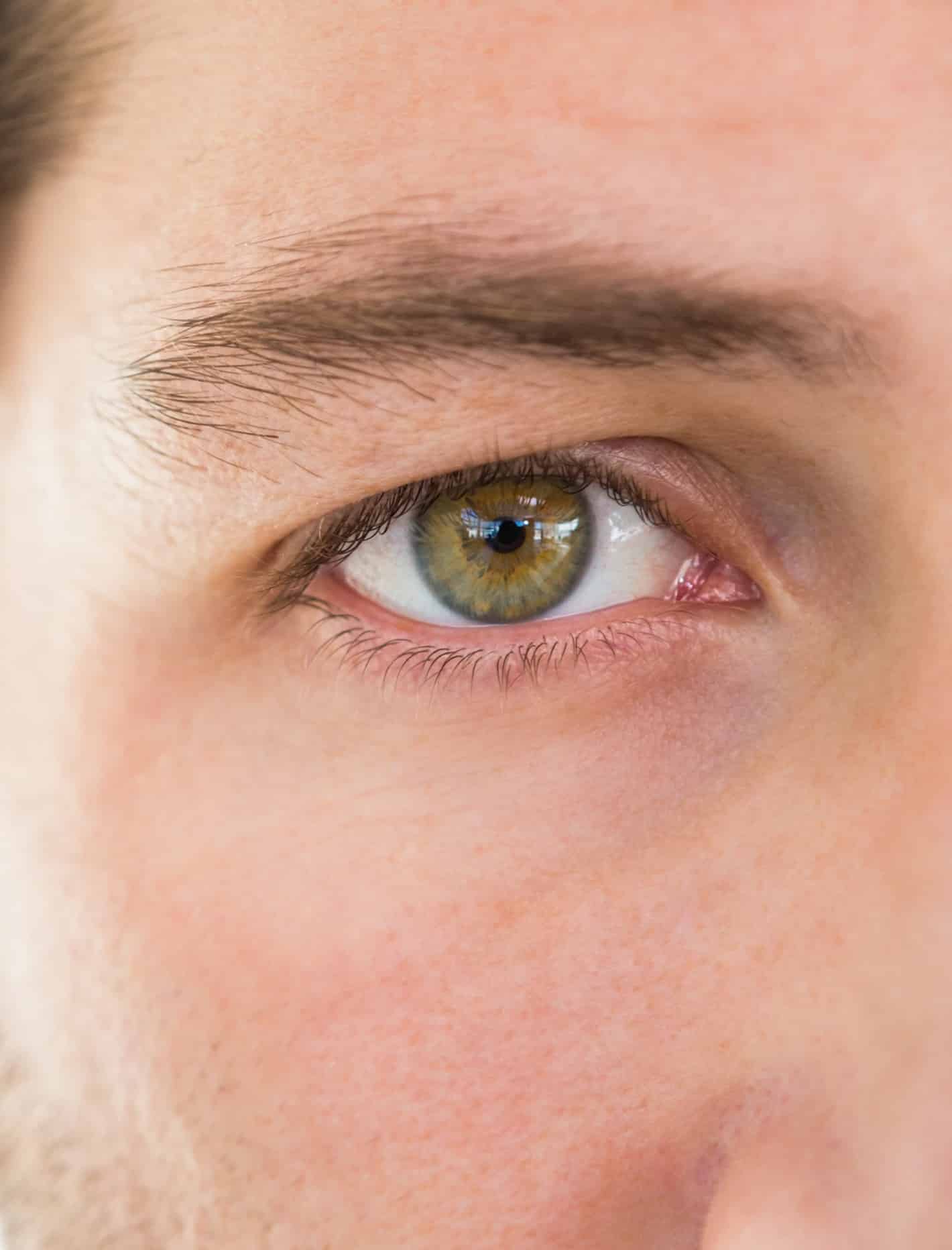 Un Oeil avec paupiere tambante en attente de blepharoplastie superieur au centre Esthetique Tremoille Paris 8