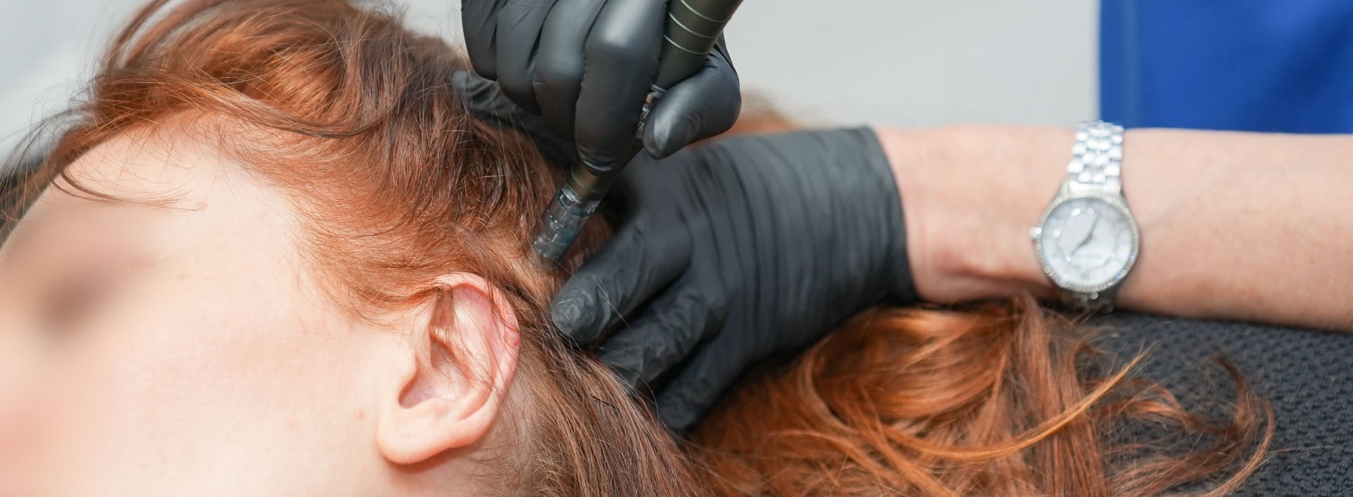 Femme subit le traitement prp microneedling au cheveux au centre esthetique et laser Tremoille de paris 8