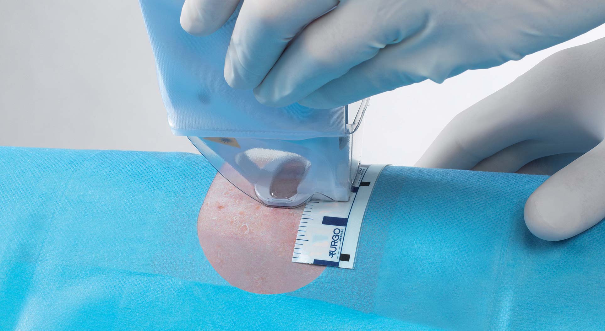 Application de laser urgotouch sur la peau pour attentuer les cicatrices au centre tremoille paris 8